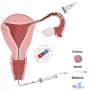 Urgent Study Develops Magnetic Microcatheters for Reproductive Health